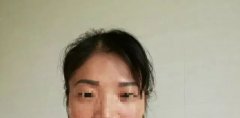 激光洗眉出现这些问题如何解决？
