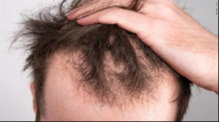 男人经常掉头发的原因是什么